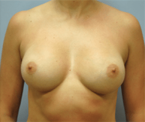 After Image: Breast Implants - front