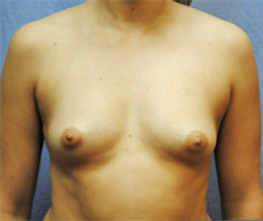 Before Image: Breast Implants - front