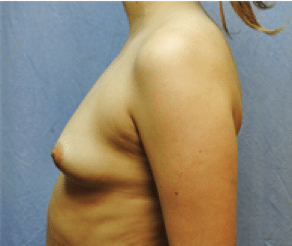 Before Image: Breast Implants - left-side
