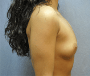 Before Image: Breast Implants - right-side