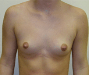 Before Image: Breast Implants - front