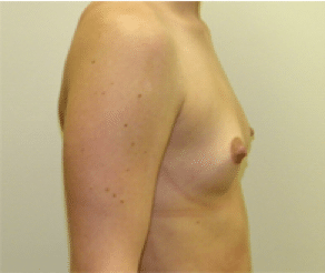 Before Image: Breast Implants - right-side