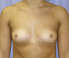 Before Image: Breast Implants - front