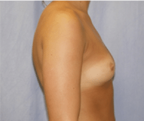 Before Image: Breast Implants - right-side