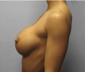 After Image: Breast Implants - left-side