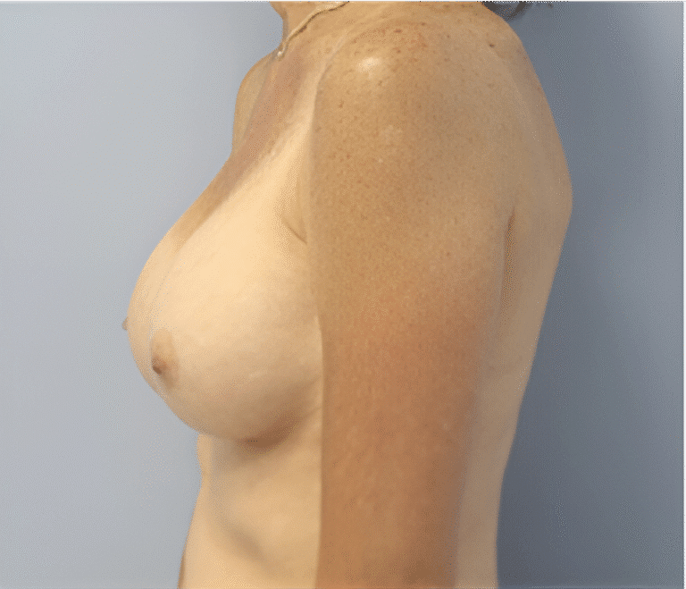 After Image: Breast Implants - left-side