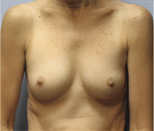 Before Image: Breast Implants
