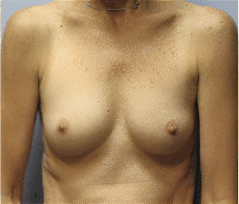 Before Image: Breast Implants - front