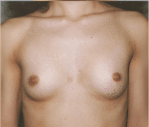 Before Image: Breast Implants