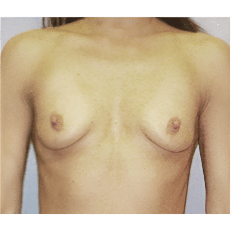 Before Image: Breast Implants - front