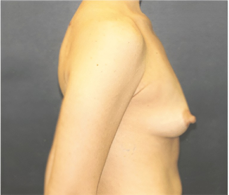 Before Image: Breast Implants - right-side