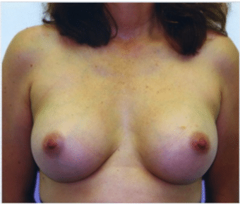 After Image: Breast Implants - front
