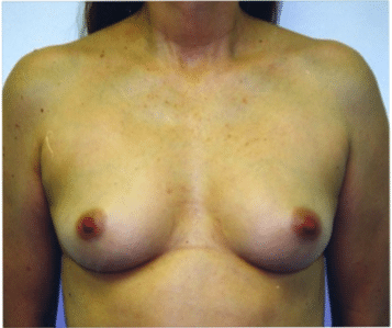 Before Image: Breast Implants - front
