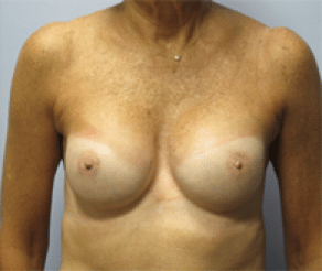 After Image: Breast Implants - front