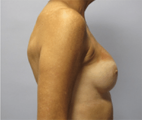 After Image: Breast Implants - right-side