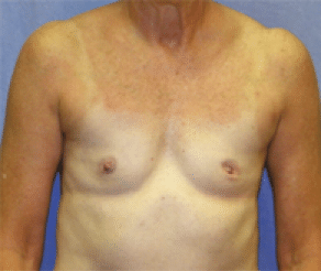 Before Image: Breast Implants - front