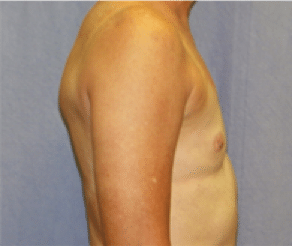 Before Image: Breast Implants - right-side