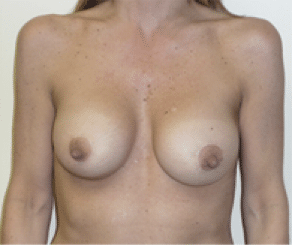 After Image: Breast Implants with Lift - front