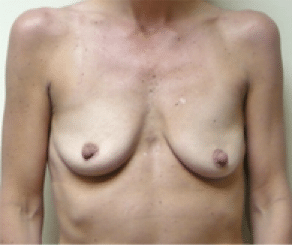 Before Image: Breast Implants with Lift - front