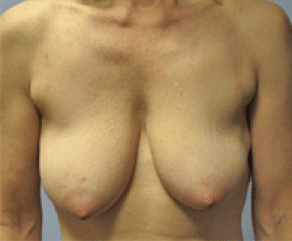 Before Image: Breast Implants with Lift - front