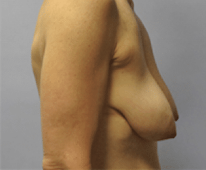Before Image: Breast Implants with Lift - right-side