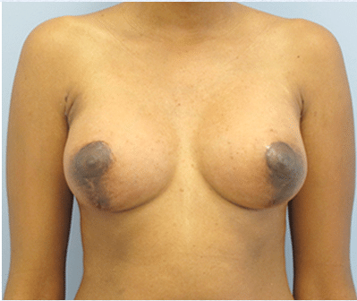 After Image: Breast Implants with Lift - front