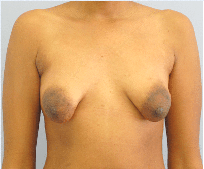 Before Image: Breast Implants with Lift - front