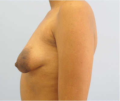Before Image: Breast Implants with Lift - left-side