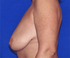Before Image: Breast Implants with Lift - left-side