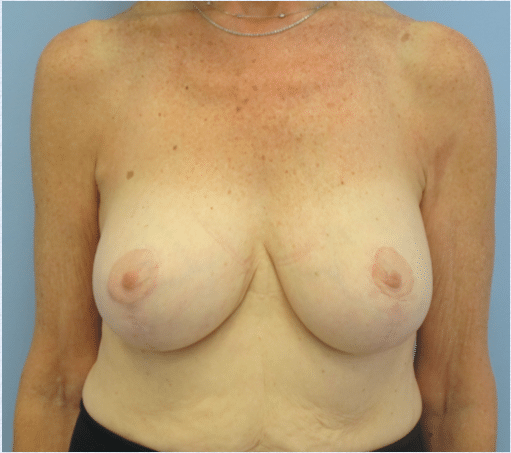 After Image: Breast Implants with Lift - front