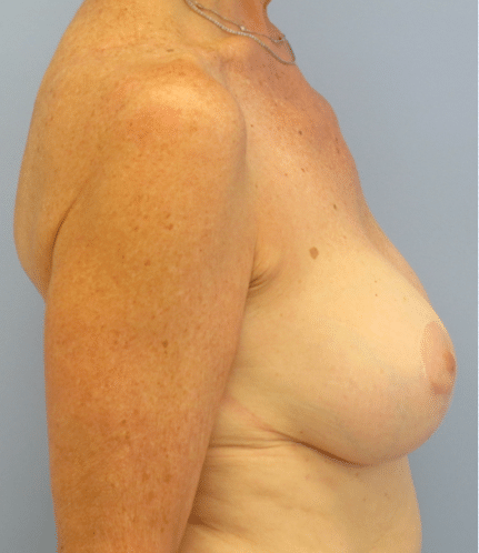 After Image: Breast Implants with Lift - right-side