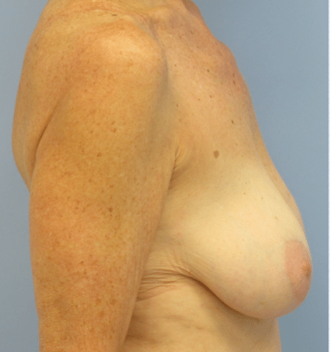 Before Image: Breast Implants with Lift - right-side