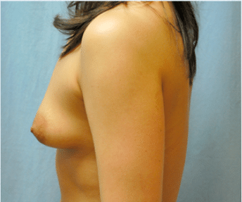 Before Image: Breast Implants with Lift - left-side