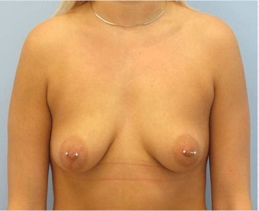 Before Image: Breast Implants with Lift - front