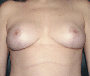 After Image: Breast Reduction - front