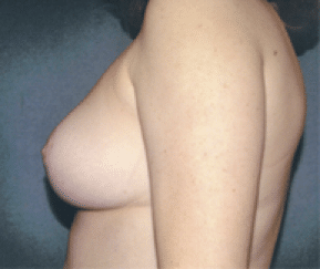After Image: Breast Reduction - left-side