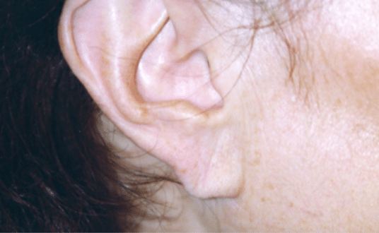 After Image: Earlobe Repair - right-side