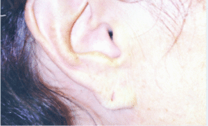 Before Image: Earlobe Repair