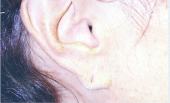 Before Image: Earlobe Repair - right-side
