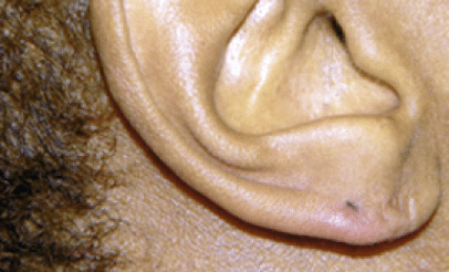 After Image: Earlobe Repair - right-side