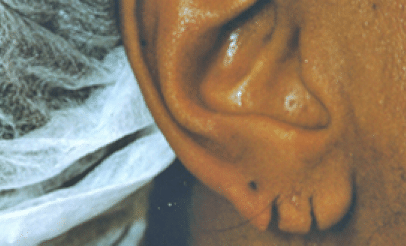 Before Image: Earlobe Repair - right-side