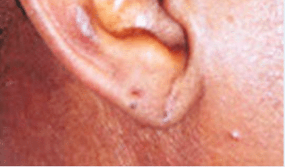 After Image: Earlobe Repair - right-side