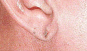 Before Image: Earlobe Repair