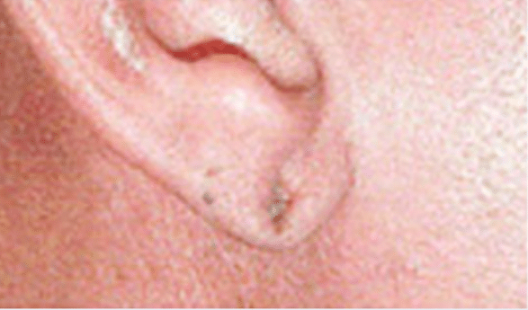 Before Image: Earlobe Repair - right-side