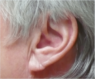 After Image: Earlobe Repair - left-side