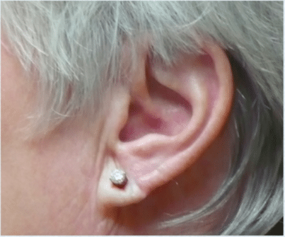 After Image: Earlobe Repair - left-side