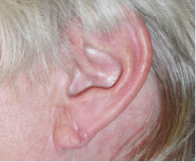 Before Image: Earlobe Repair - left-side