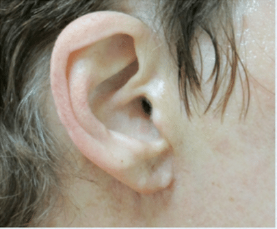 After Image: Earlobe Repair - right-side