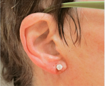 After Image: Earlobe Repair - right-side