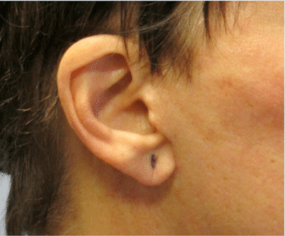 Before Image: Earlobe Repair - right-side